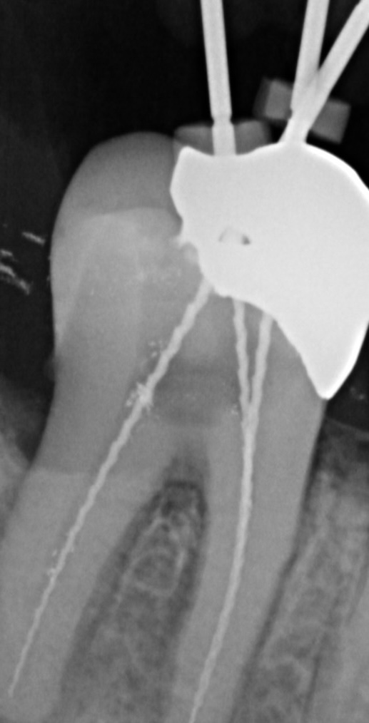 Wurzelkanalbehandlung Röntgenbild
